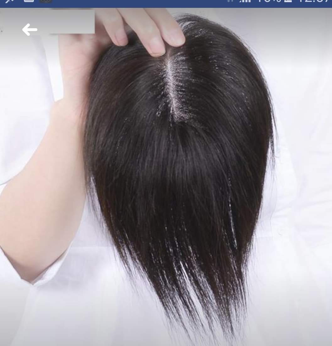 Người phụ nữ ở TPHCM mắc bệnh lạ đột nhiên rụng tóc hói nửa đầu